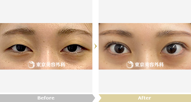 安田康祐医師による眼瞼下垂と目の上のたるみ取りの症例