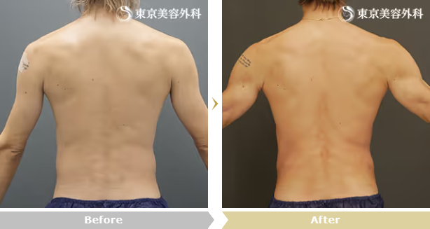 中居弘一医師によるベイザー脂肪吸引（腰部）の症例