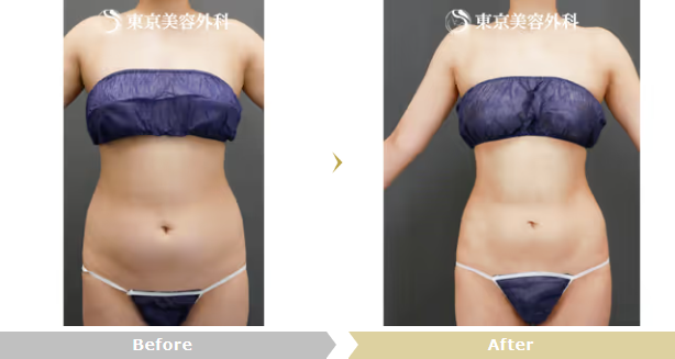中居弘一医師による女性のベイザー脂肪吸引（お腹・腰）の症例