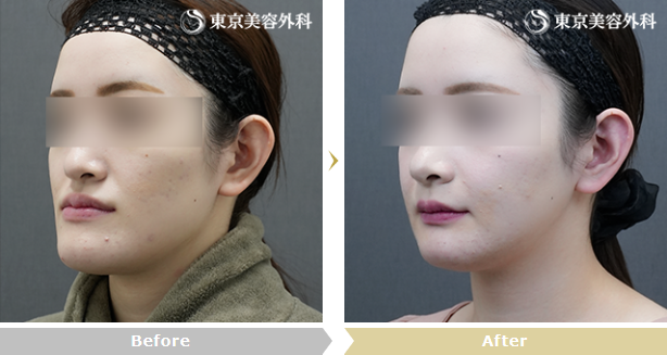 柘植琢哉医師による頬骨形成の症例