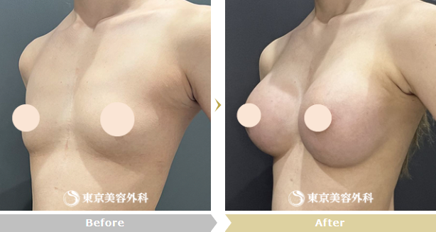柘植琢哉医師による豊胸症例