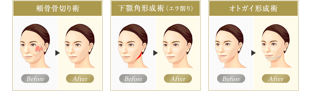 BAイラスト（頬骨骨切り術、下顎角形成術（エラ削り）、オトガイ形成術）
