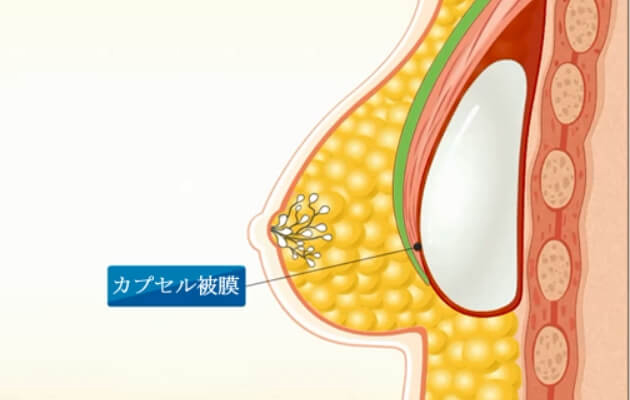 カプセル拘縮とは