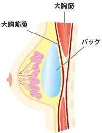 乳腺下法