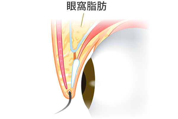 まぶたの脂肪が多い方