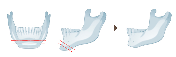 水平骨切り術による顎(オトガイ)骨切りイメージ