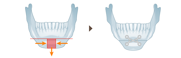 顎Vライン形成のための垂直骨切り術のイメージ