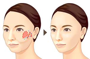 頬骨の輪郭矯正(アーチ・インフラクチャー法)イメージ