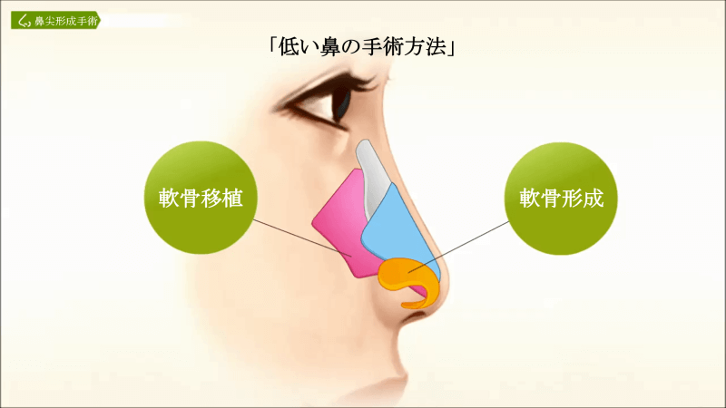 低い鼻の鼻尖形成手術