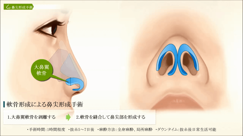 軟骨形成による鼻尖形成手術