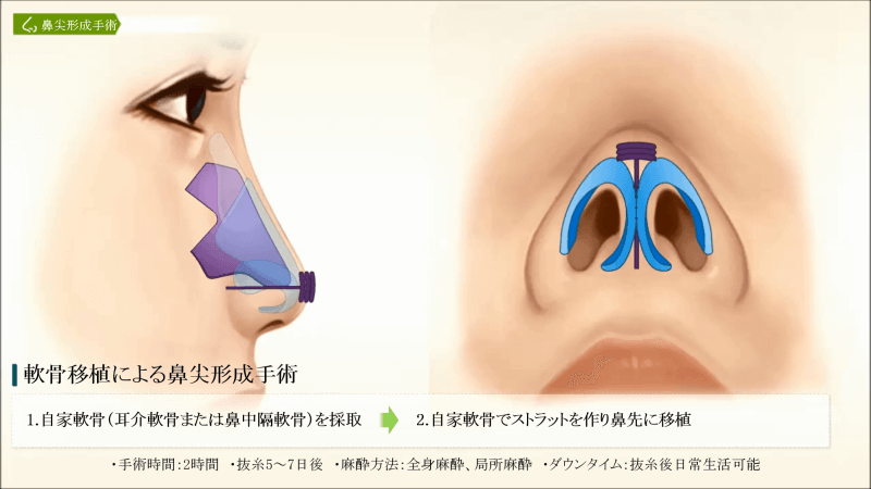 軟骨移植による鼻尖形成手術