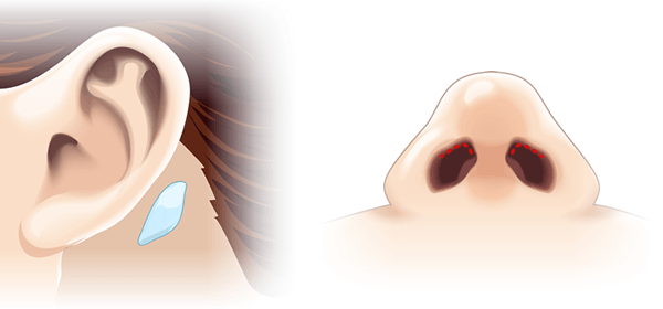 鼻孔緑形成の手術イメージ