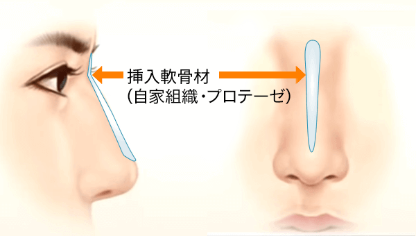 外人のように鼻筋が通った存在感のある鼻にしたい方のプロテーゼ挿入位置