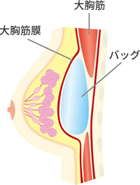 胸筋膜下法は大胸筋膜内にバッグを挿入します